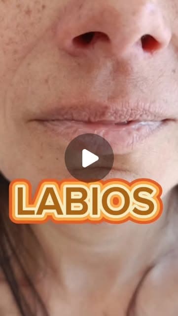 Publicación de Advance sobre un perfilado labial con ácido hialurónico