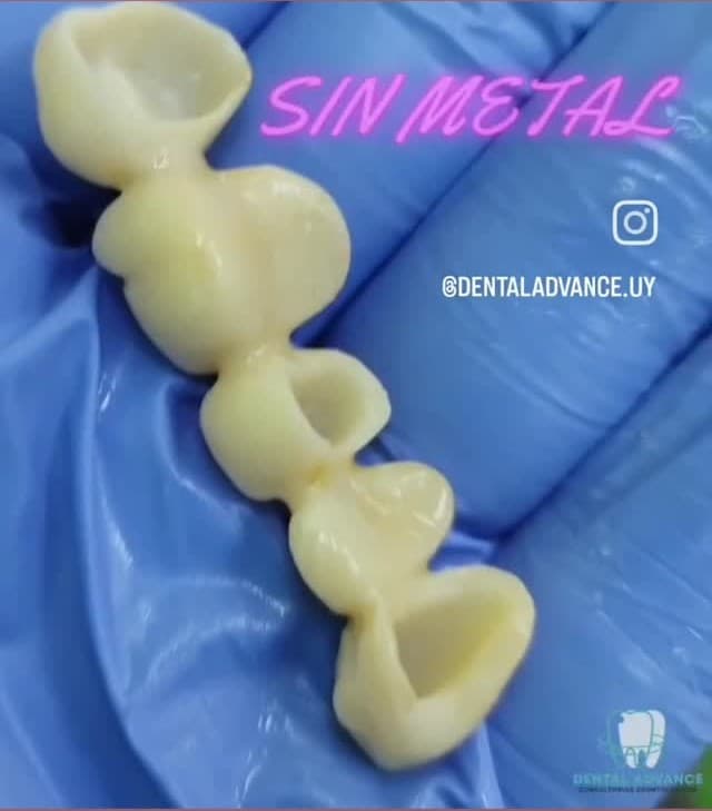 Publicación de Advance sobre un puente odontológico de zirconio sin metal